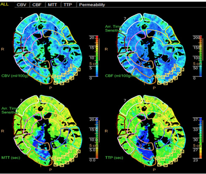 CT-scan die laat zien welke delen van het brein voldoende doorbloed zijn en welke niet. Overzicht gemaakt met behulp van IntelliSpace Portal 9.0. 