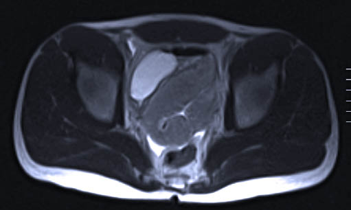 MRI-onderzoek laat zien dat het met vloeistof gevulde condoom zich in het ileum bevindt, craniaal van de blaas.