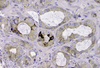 Rijpe (lichtbruin) en onrijpe (donkerbruin) prostaatkankercellen. beeld: Arno van Leenders