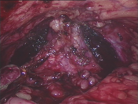 Links een endoscopisch beeld van de prostaat. 
