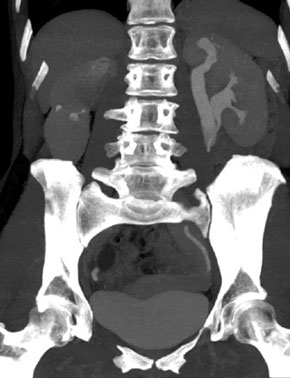 2. CT-abdomen met excretiefase, coronale coupe. Dubbelsysteem (op deze coupe alleen links zichtbaar) met mega-ureter uitgaande van de bovenpool en een slanke ureter uitgaande van de onderpool.