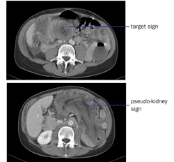 CT-scan van het abdomen met een typisch target sign (boven) en (onder) met transversale beeldvorming van een pseudo-kidney sign.