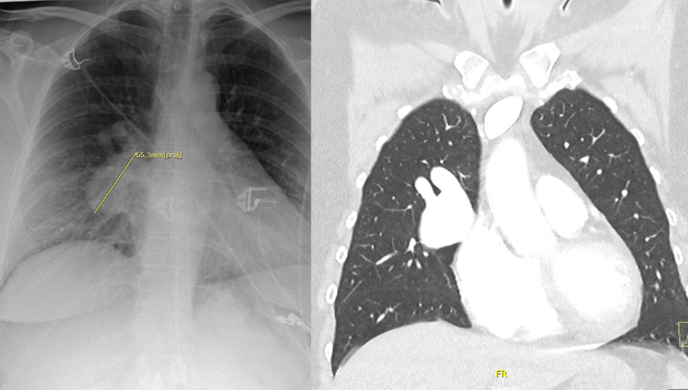 Links: X-thorax met bolronde afwijking  (links). Rechts: Pulmonale arterioveneuze malformatie (PAVM)    