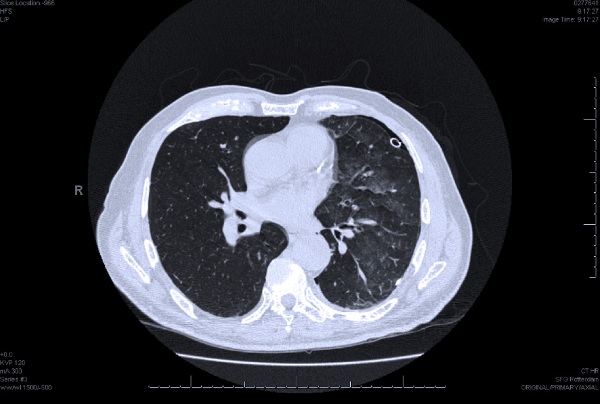 De CT-scan toont een matglasbeeld in de linkerlong.