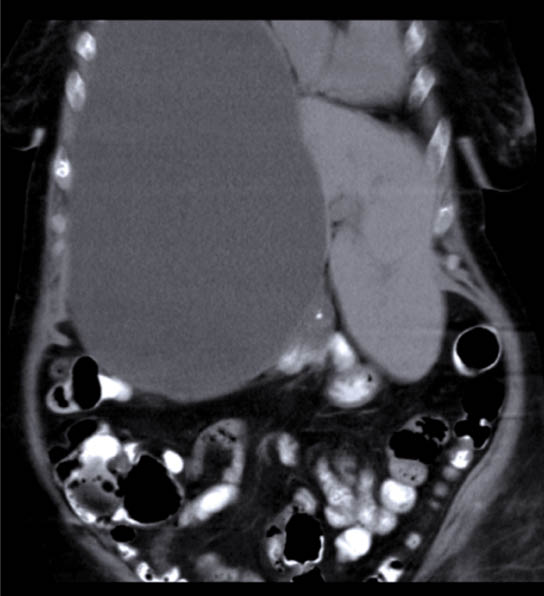 CT-abdomen met daarin een grote zwelling van 25x17x17 cm, uitgaande van de rechterleverkwab.