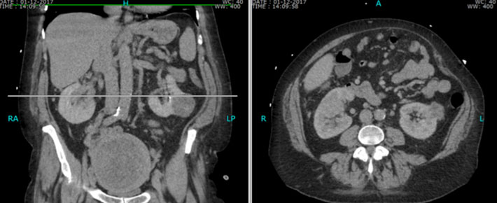 2. CT-scan toont in de nier links een corticale massa van ca. 4,7 cm en in de nier rechts een centrale massa op het niveau van de hilus van ca. 4,5 cm. 
