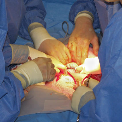 Bij het openen van het peritoneum bleken al een handje, een deel van het caput en een deel van de placenta uit de uterus te komen.